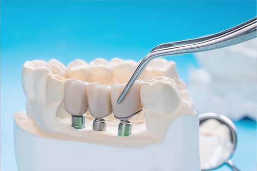 dental implants bentleigh