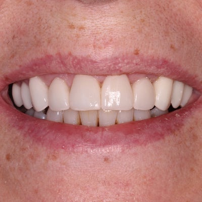dental veneers after smile 15 edentist