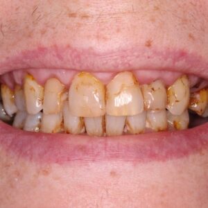 dental veneers before smile 15 edentist
