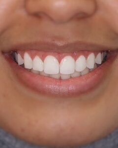 gingivectomy before edentist bentleigh