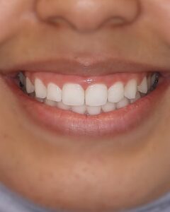 gingivectomy before edentist bentleigh