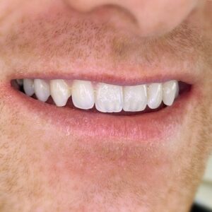 dentist before and after 2 edentist bentleigh